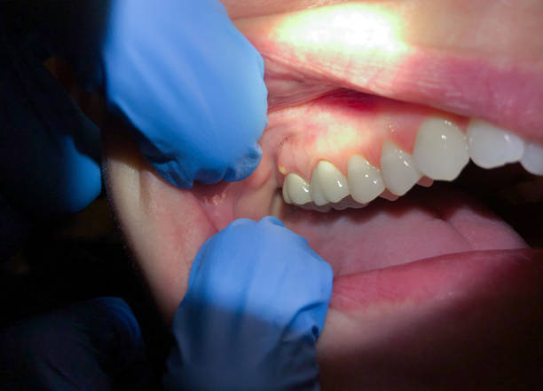 Teeth Whitening in AL