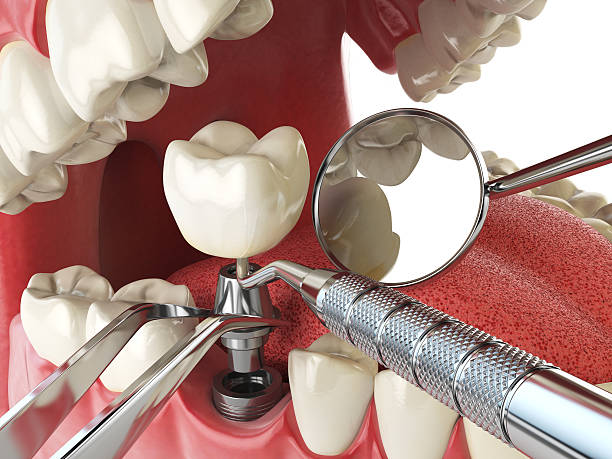 Best Broken Tooth Emergency  in Lincoln, AL